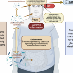 Lire la suite à propos de l’article Le lien entre le microbiote et le galucome – maladie oculaire caractérisée par des dommages progressifs du nerf optique