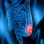 Lire la suite à propos de l’article Le microbiote et le cancer : un lien émergent.